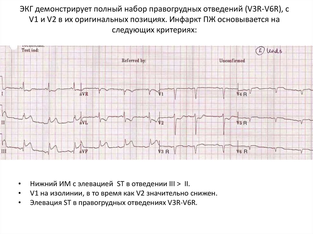 Экг 3. ОИМ правого желудочка на ЭКГ. Инфаркт правого желудочка на ЭКГ. Инфаркт миокарда правого желудочка на ЭКГ. Инфаркт нижней стенки на ЭКГ.