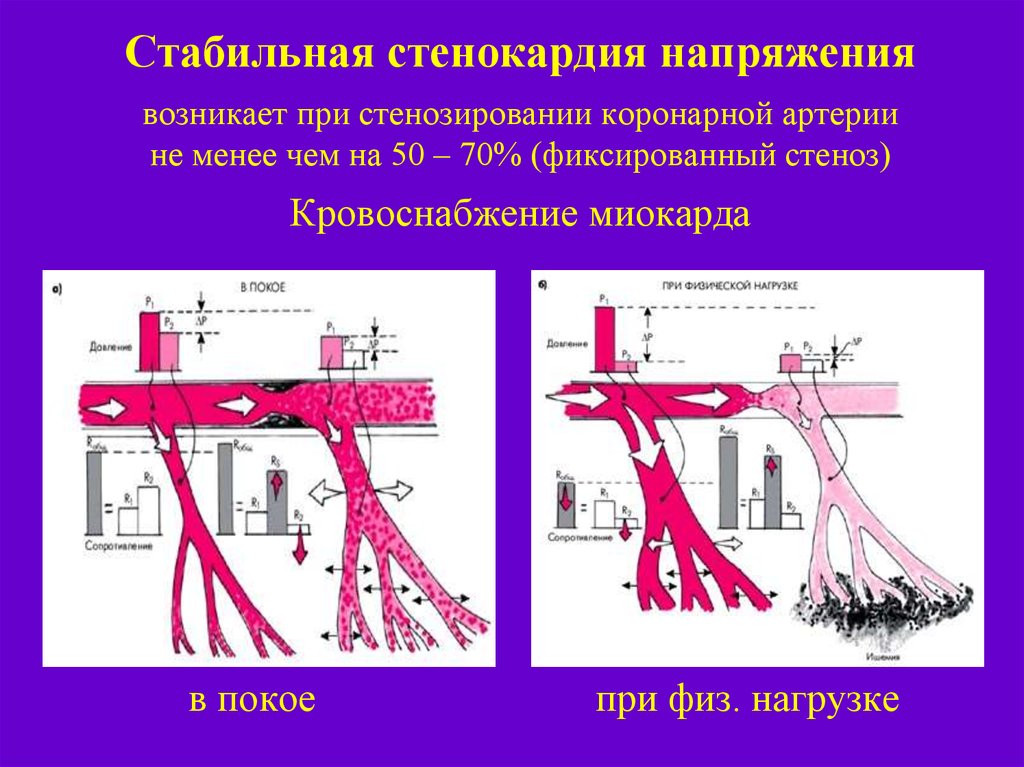 Стабильная стенокардия что это