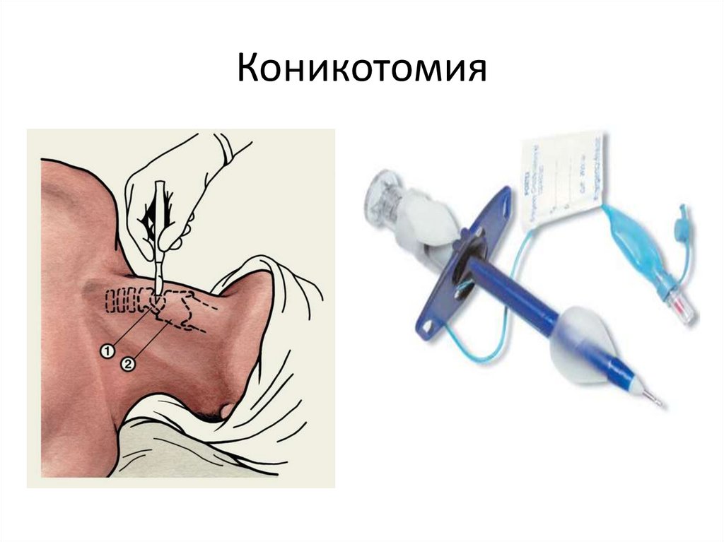 Трахеостома показания. Техника операции коникотомии. Интубация трахеи коникотомия. Пункционная коникотомия. Коникотомия анатомические ориентиры.