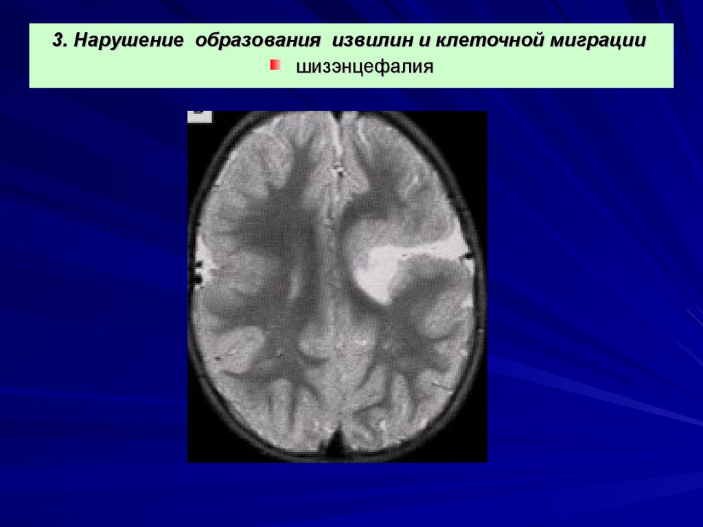 Шизэнцефалия мрт картинки