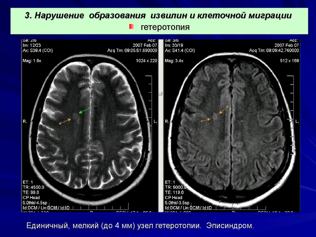 Органические изменения головного. Эписиндром. Гетеротопия в веществе мозга. Эписиндром мрт. Эписиндром у детей симптомы.