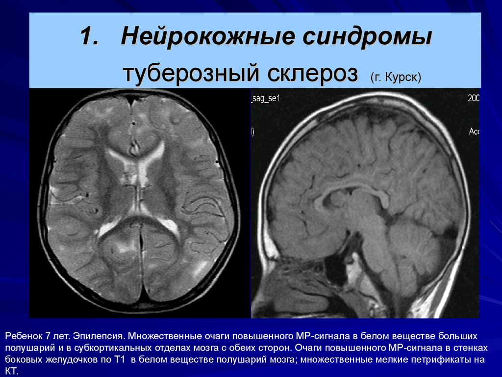 Мозговой склероз. Туберозный склероз на кт головного мозга. Туберозный склероз (болезнь Бурневилля). Туберозный склероз мрт. Туберозный склероз при кт.