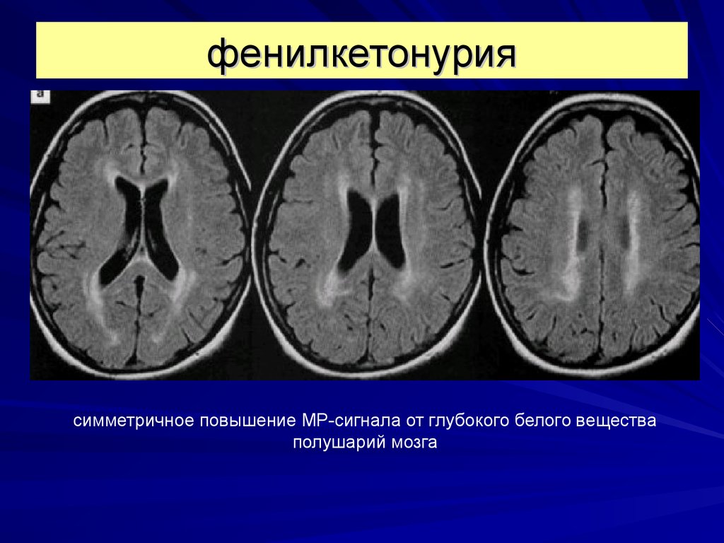 Органические изменения головного. Мрт головного мозга при фенилкетонурии. Головной мозг при фенилкетонурии. Врожденные заболевания головного мозга.