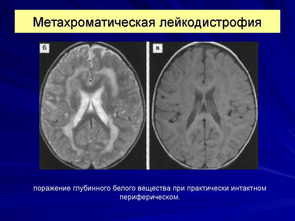 Лейкодистрофия это. Метахроматическая лейкодистрофия. Метахроматическая лейкодистрофия мрт. Болезнь лейкодистрофия. Лейкодистрофия Шольца-Гринфилда).