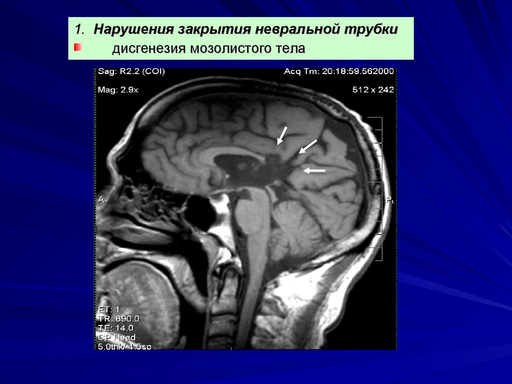 Гипоплазия правой головного мозга. Мозолистое тело анатомия мрт. Дисгенезия мозолистого тела мрт. Агенезия мозолистого тела на кт. Дисгенезия мозолистого тела у плода.