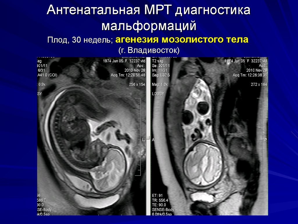 Внутриутробное поражение головного мозга. Антенатальная диагностика мрт. Мрт плода агенезия мозолистого тела.