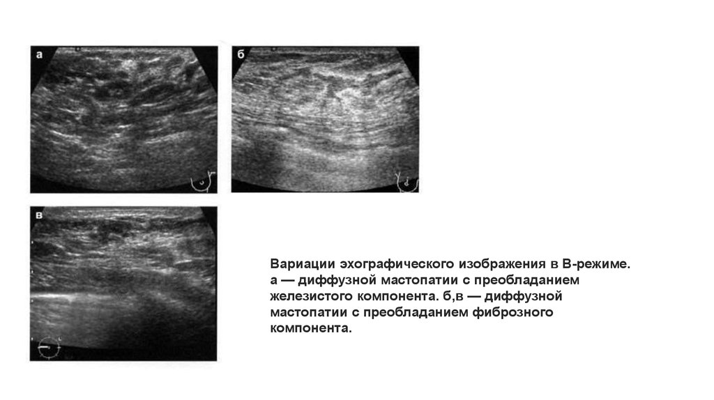 Мастопатия молочной железы узи
