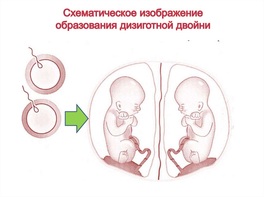 Виды близнецов схема