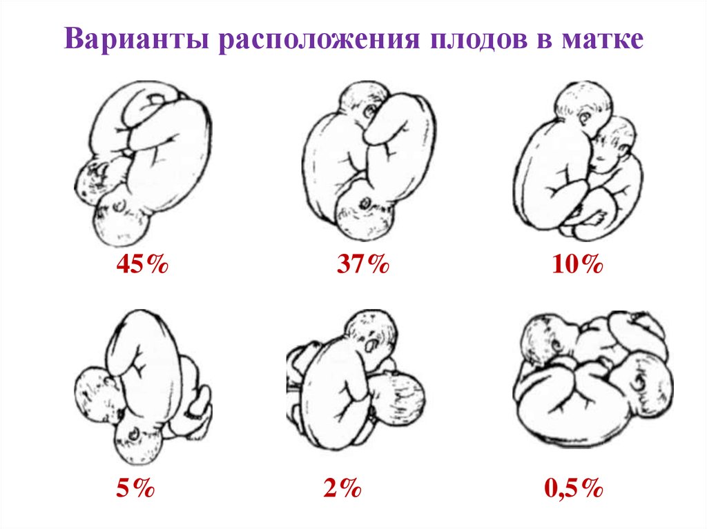 Беременность схема расположения