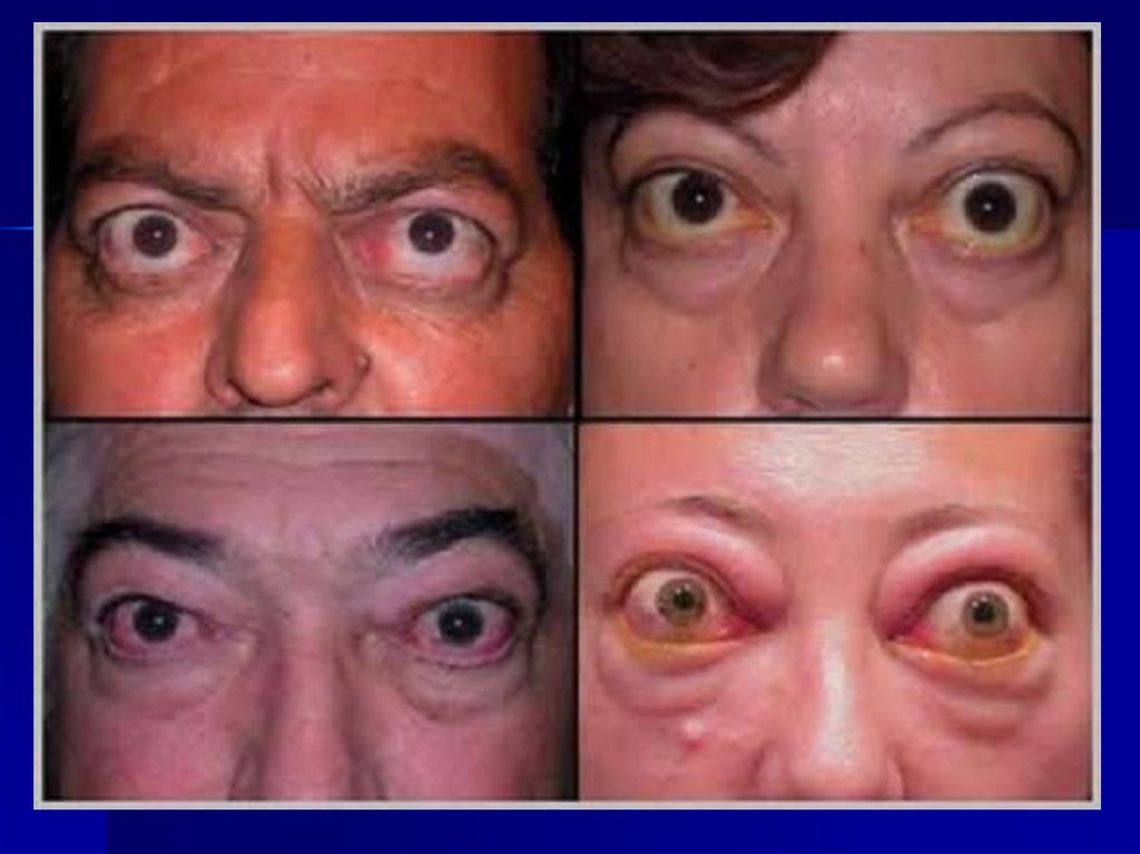 Почему вылезают глаза. Офтальмопатия Грейвса. Тиреотоксикоз офтальмопатия. Эндокринная офтальмопатия.