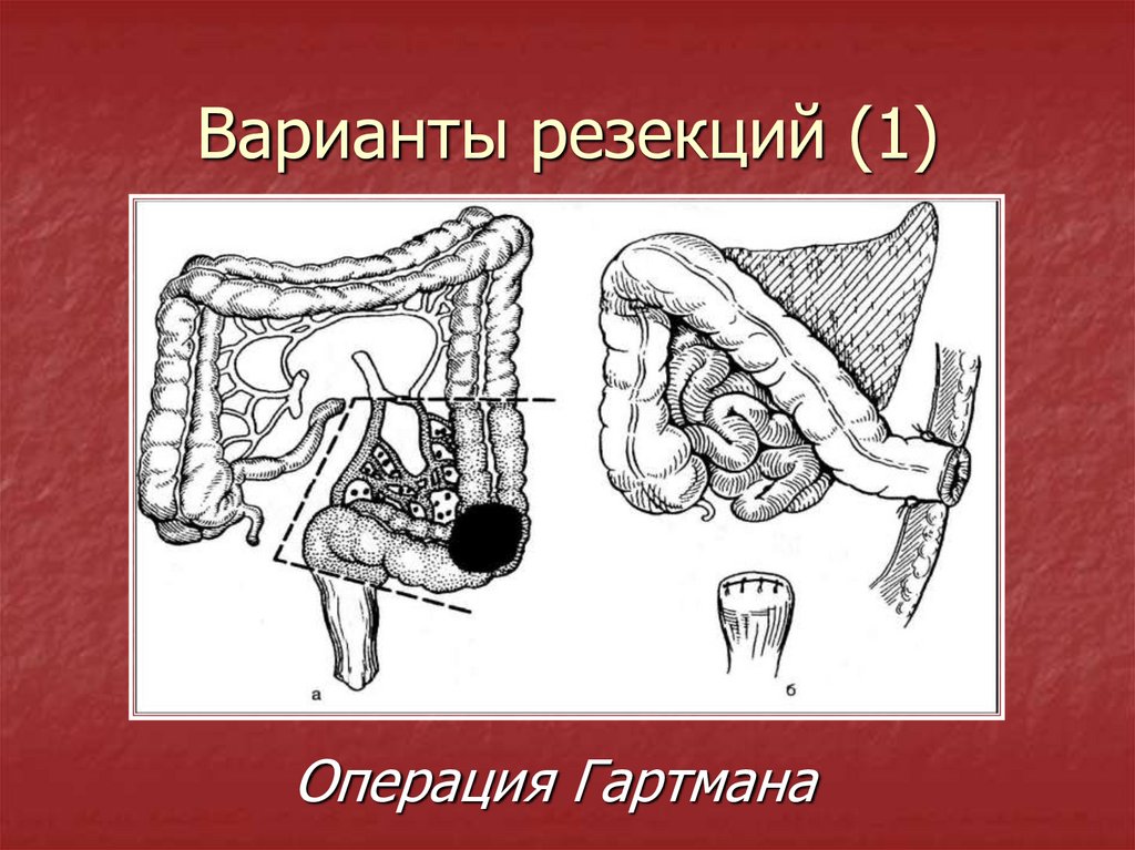 Колостома двуствольная схема