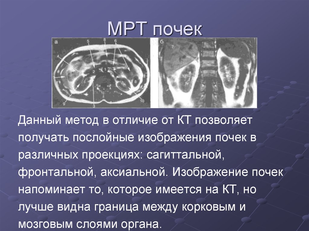 Лучевая диагностика почек презентация