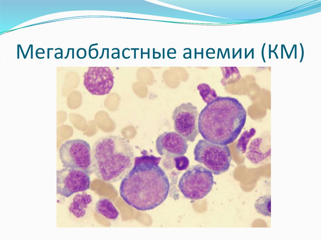 Картина крови при мегалобластной анемии