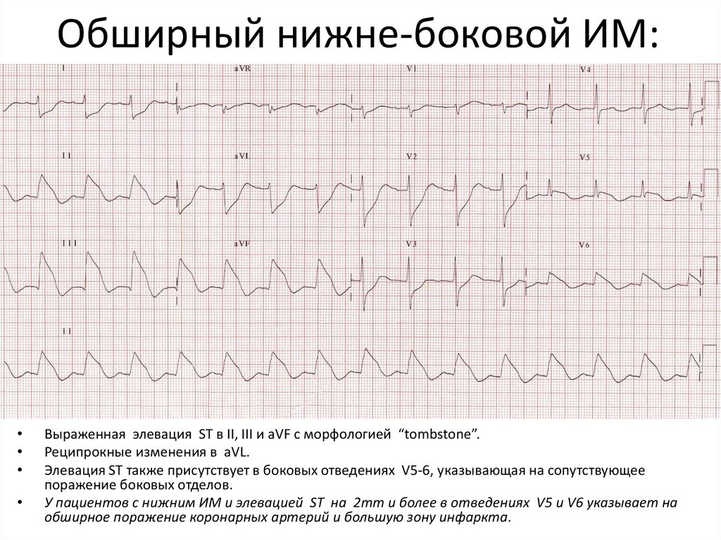 Нарушение нижней стенки. По ЭКГ инфаркт в II,III, AVF. Обширный инфаркт миокарда на ЭКГ. Обширный инфаркт ЭКГ. Обширный трансмуральный инфаркт.