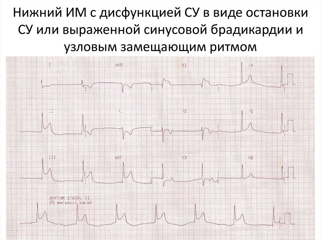 Синусовая брадикардия неполная. Желудочковая брадикардия на ЭКГ. Синусовая брадикардия аускультация. Синусовая брадикардия при инфаркте миокарда. Синусовая брадикардия на ЭКГ.