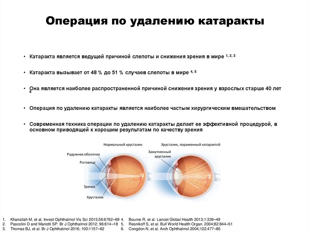 Операция катаракты новосибирск