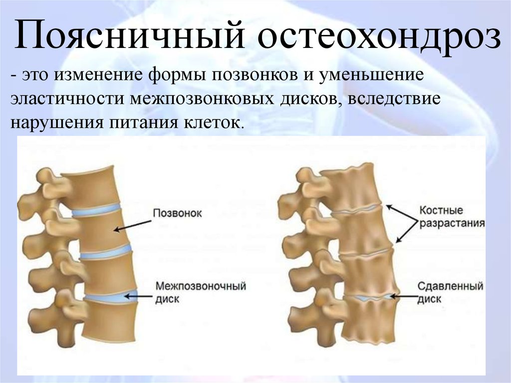 Остеохондроз поясничного отдела