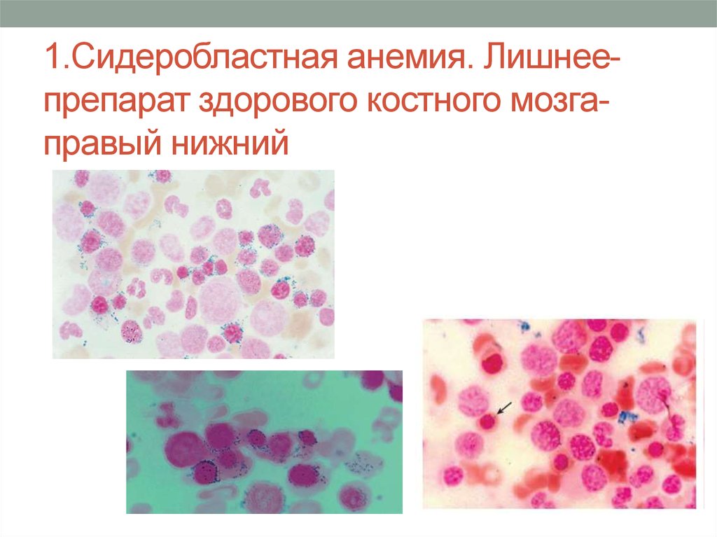 Сидеробластная анемия презентация