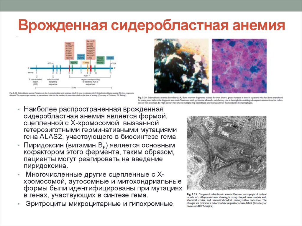 Сидеробластная анемия презентация