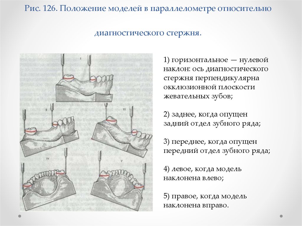 Параллелометрия в стоматологии презентация