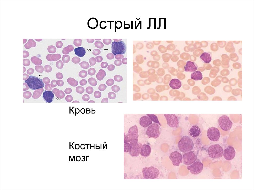 Возбудитель лейкоза. Острый лейкоз костный мозг. Осложнения острого лейкоза.