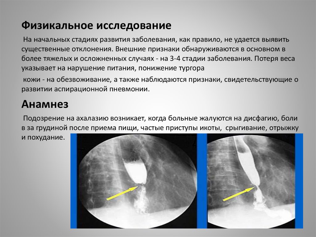 Какой из перечисленных симптомов является ведущим в рентгенологической картине ахалазии пищевода