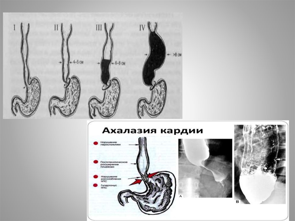 Схема ахалазия кардии