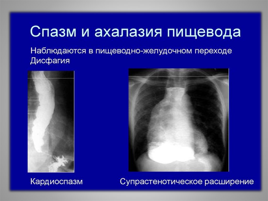 Спазмы кардии. Ахалазия пищевода рентген. Рентген халащия пищевода. Ахалазия пищевода рентгенодиагностика. Ахалазия пищеводно-желудочного перехода.