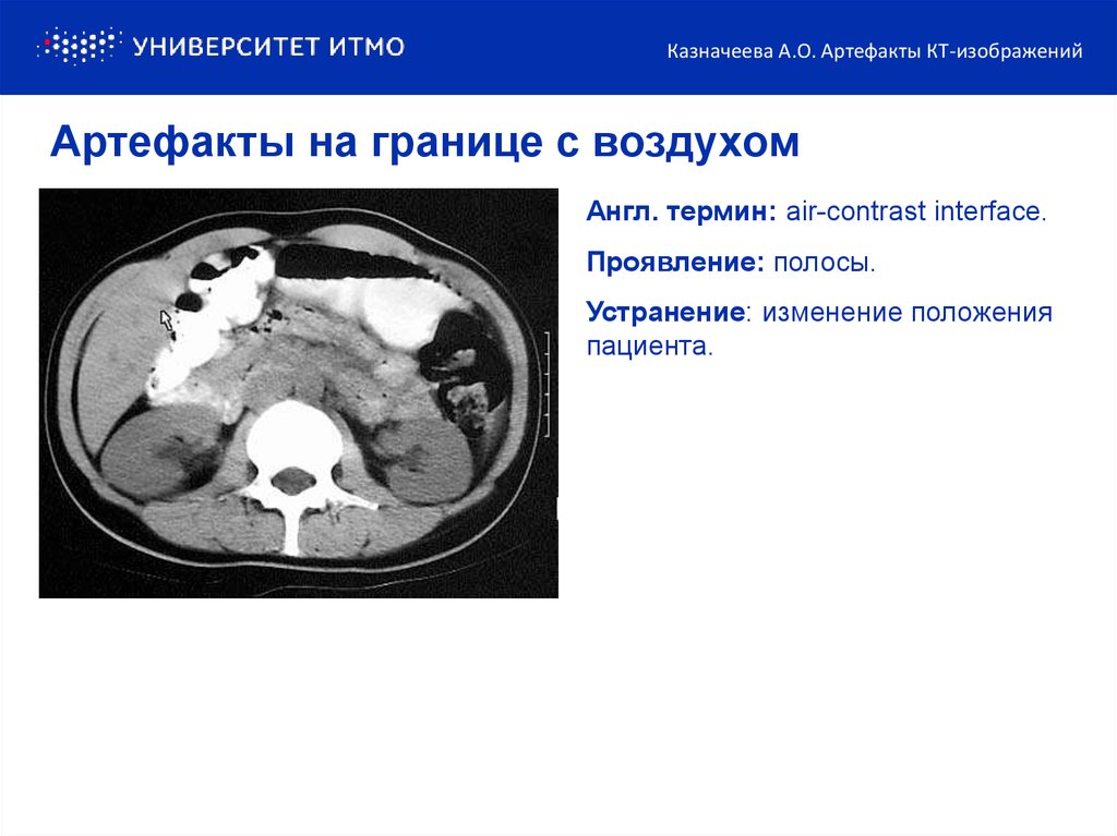 Артефакты дыхания. Артефакты от металла на кт. Артефакты кт изображений. Дыхательные артефакты на кт. Кт изображение.