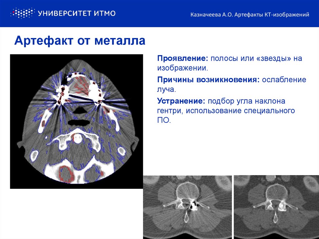 Артефакты мрт презентация