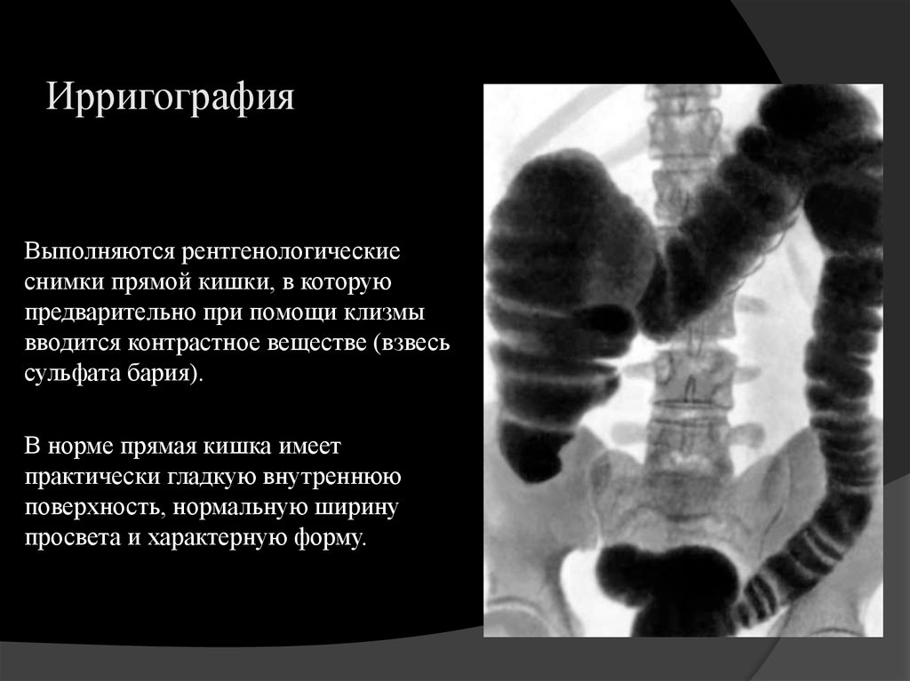 Ирригоскопия это рентгенологическое контрастное исследование. Рентгенологическое исследование Толстого кишечника (ирригоскопия).. Ирригоскопия Толстого кишечника рентген. Ирригоскопия опухоль сигмовидной кишки. Опухоль толстой кишки рентген.