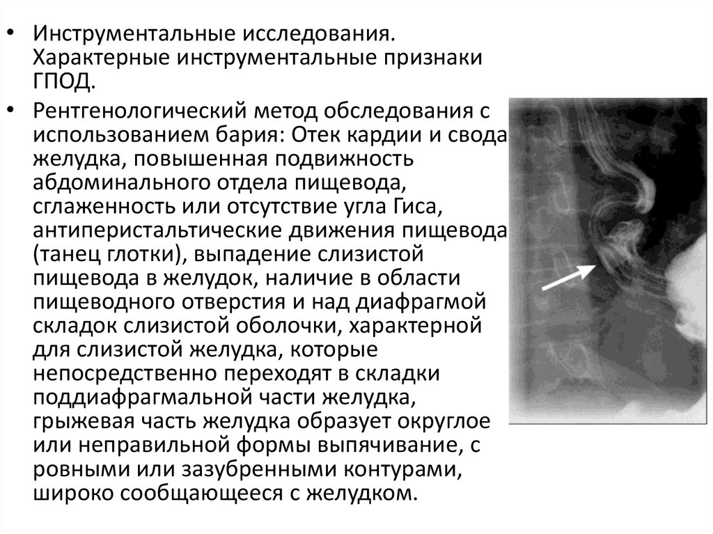 Грыжа пищевода симптомы. Протокол рентген описание грыжи пищеводного отверстия. Рентгенологические симптомы грыжа пищеводного отверстия диафрагмы. Диафрагмальная грыжа рентген описание. Скользящие грыжи пищеводного отверстия диафрагмы рентген.