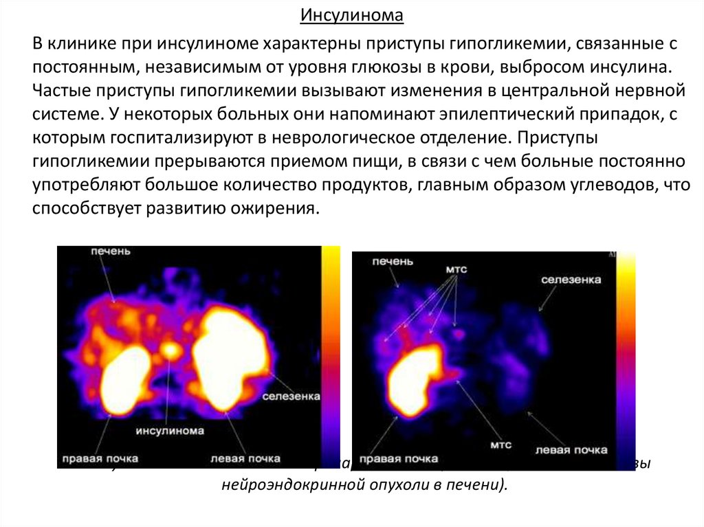 Гипогликемия на фоне голода