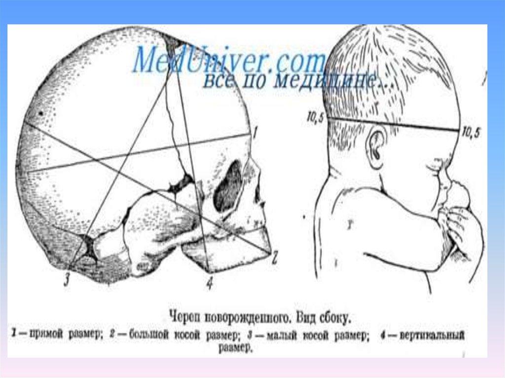 Прямой размер головки плода