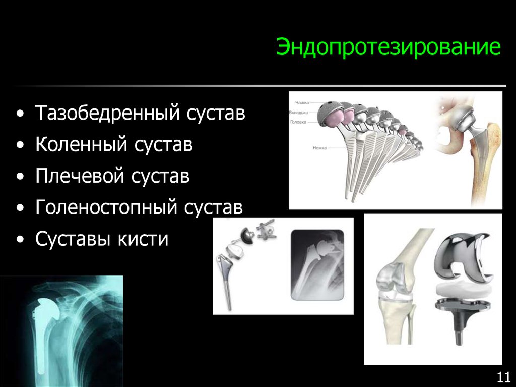 Презентация эндопротезирование плечевого сустава