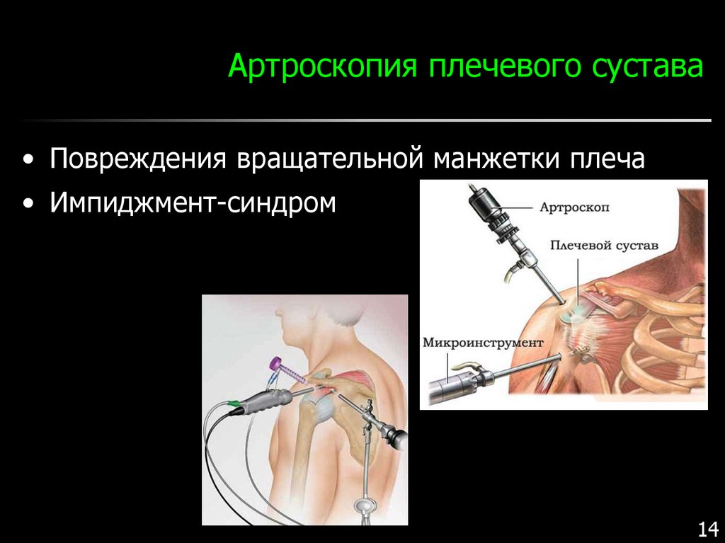 Артроскопия плечевого сустава реабилитация. Протокол операции артроскопии плечевого сустава. Артроскопия плечевого сустава. Артроскопия лицевого сустава. Артроскопия gkxtdjuj сустава.