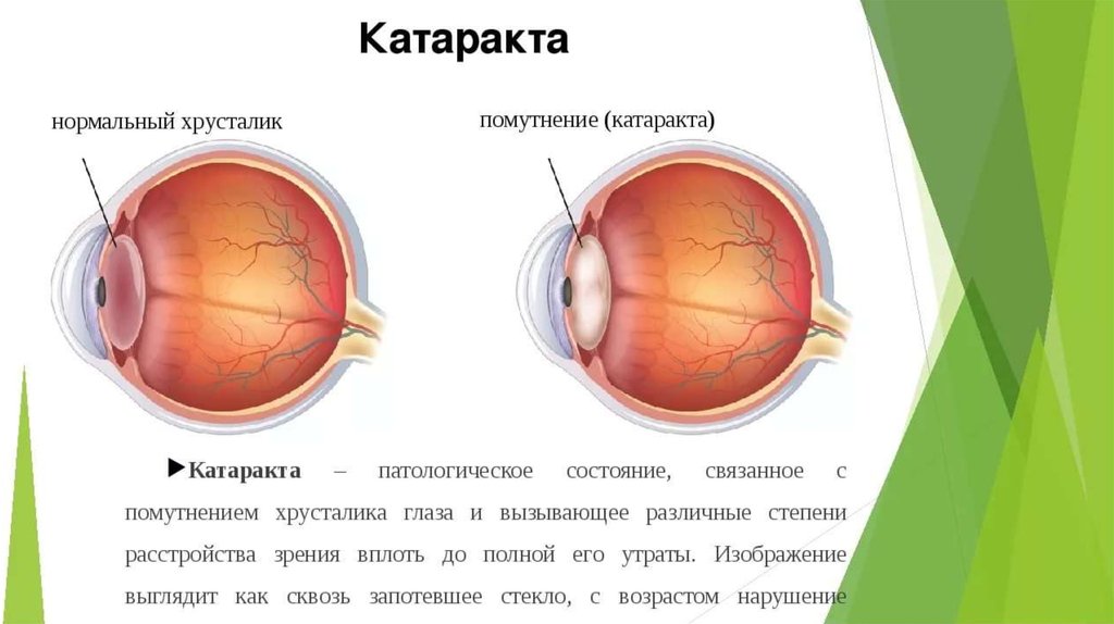 Глаукома презентация офтальмологии