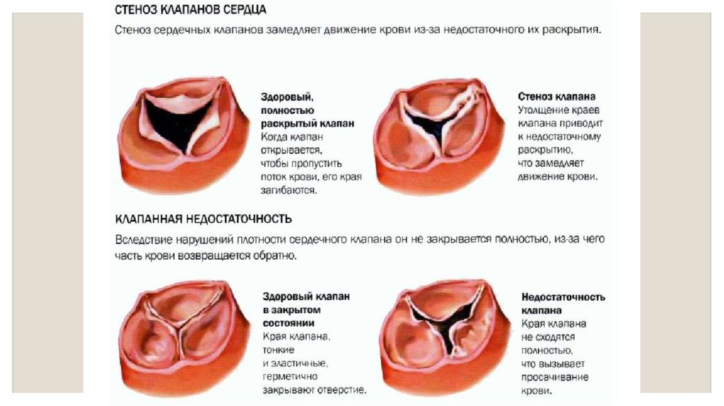 Фиброз клапанов