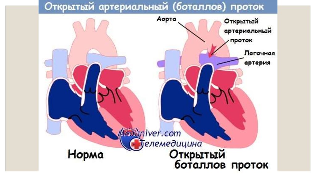 Открытый артериальный проток картинки