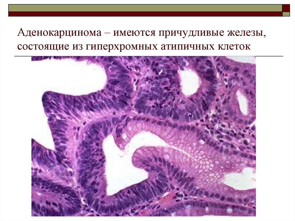 Аденокарцинома это. Аденокарцинома желудка микропрепарат. Паренхима опухоли Строма опухоли. Аденокарцинома микропрепарат описание. Аденокарцинома с распадом.