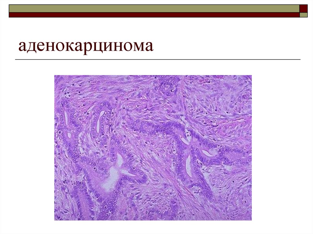 Что такое аденокарцинома. Строение аденокарциномы. Аденокарцинома легкого препарат. Аденокарцинома потовых желез. Аденокарцинома легких микропрепарат.