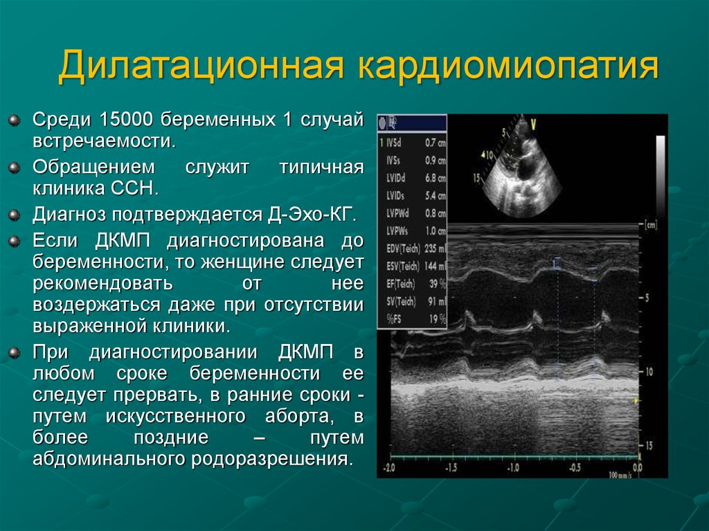 Дилатационная кардиомиопатия что это такое. ЭХОКГ признаки дилатационной кардиомиопатии. Эхокардиография при дилатационной кардиомиопатии. УЗИ признаки ДКМП.