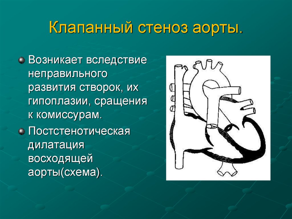 Дилатация восходящей аорты. Надклапанный аортальный стеноз.