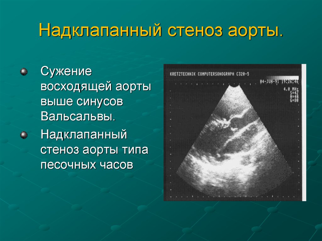 Надклапанный аортальный стеноз. Аневризма синуса Вальсальвы ЭХОКГ. Аортальный стеноз ЭХОКГ. Надклапанный стеноз аорты.