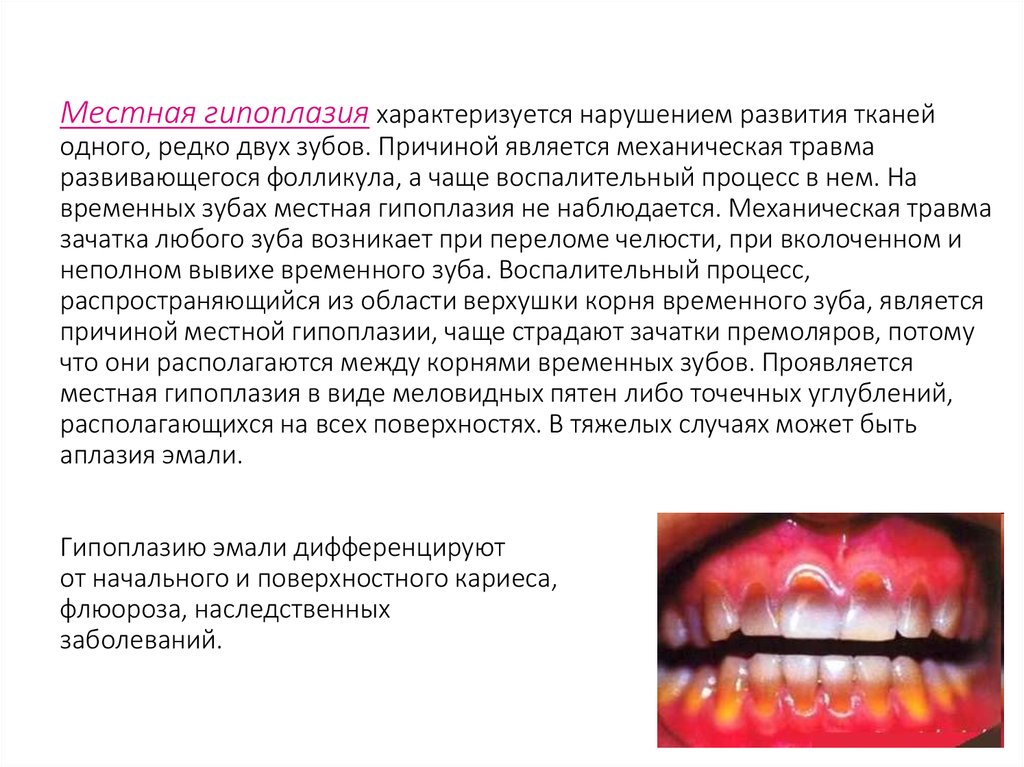 Местная гипоплазия характеризуется нарушением развития тканей одного, редко двух зубов. Причиной является механическая травма