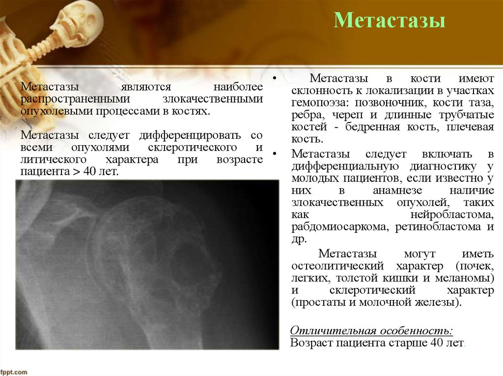 Метастазы в кости срок жизни. Метастатические опухоли костей. Метастазы опухоли костей. Опухоли метастазирующие в кость. Метастазы в кости рентгенодиагностика.