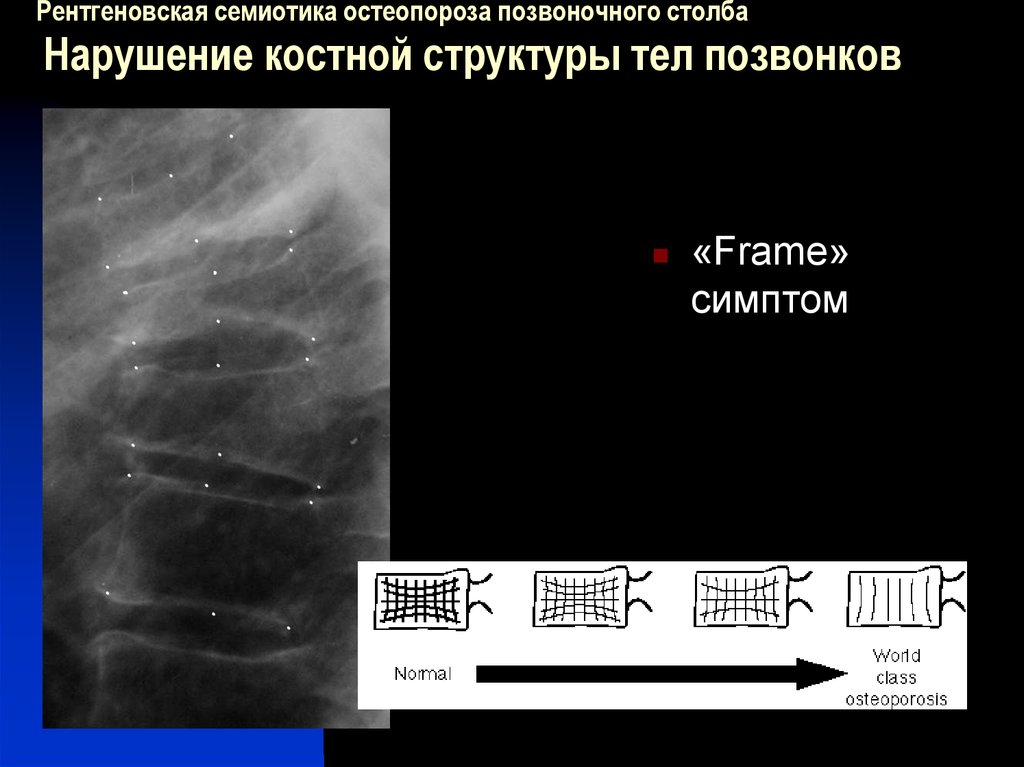 Рентгеновская семиотика это. Остеопороз семиотика. Остеопороз рентгенологические признаки. Остеопороз классификация рентген.