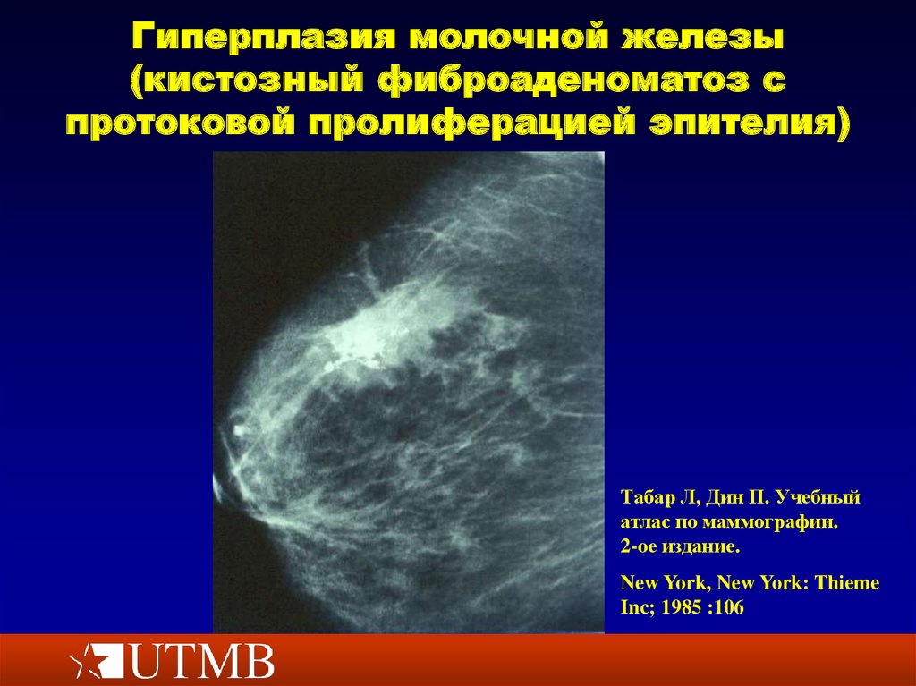 Слабый диффузный. Гиперплазия железистой ткани молочной железы. Узловая гиперплазия железистой ткани молочной железы. Фиброзно кистозная фиброаденоматоз молочной железы. Мастопатия на маммографии.