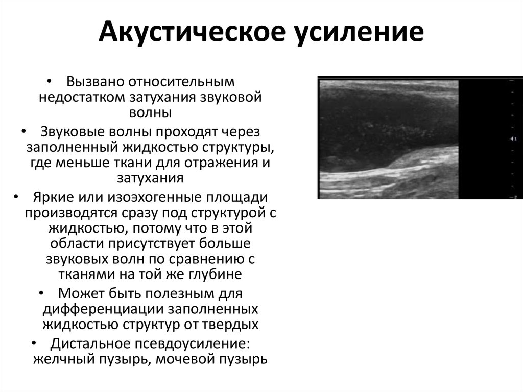 Эффект усиления. Усиление Акустическое Акустическое на УЗИ. Дистальное Акустическое усиление. Дистальное усиление на УЗИ это. Эффект дистального усиления.