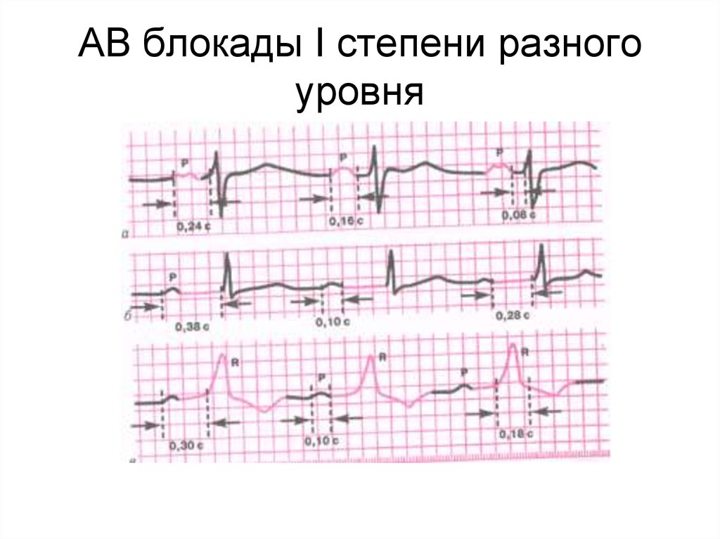 Ав блокада карта вызова